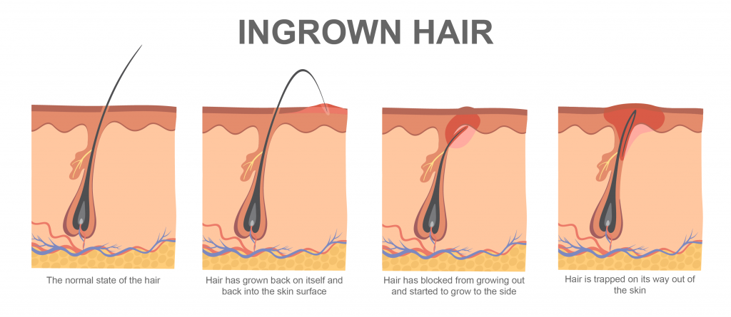 Poils incarnés - Association canadienne de dermatologie
