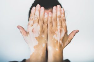 example of vitiligo on a person's hands
